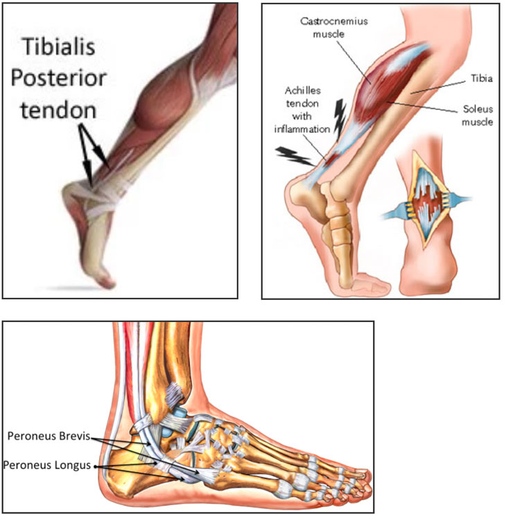 Return of strength after Achilles tendon surgery